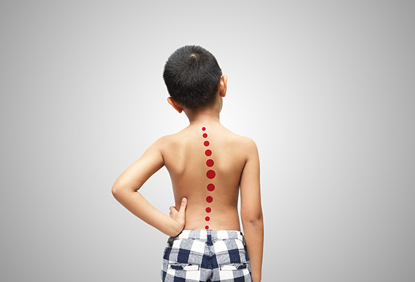 Image showing the curvature of the spine on a young boy: Scoliosis in Children